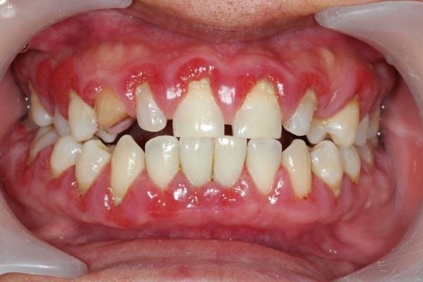 10 вопросов стоматологу о заразности кариеса правильном уходе и лечении зубов во время пандемии