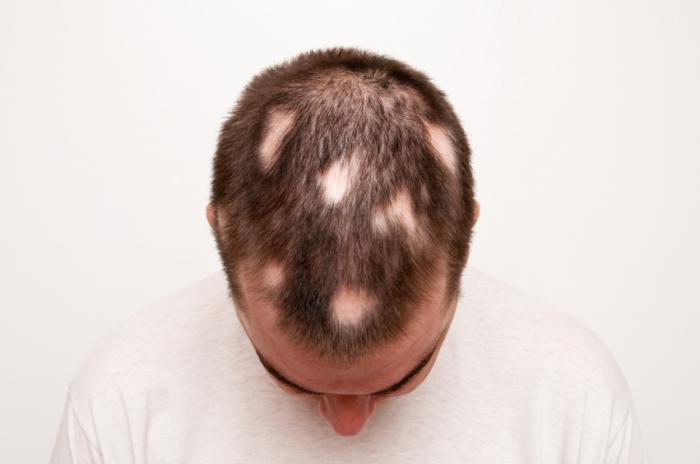 Почему выпадают волосы 3 очевидные причины о которых все забывают