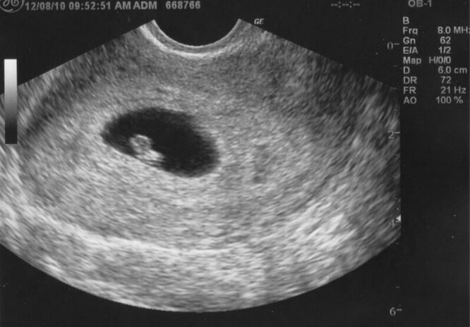 1-6 неделя беременности