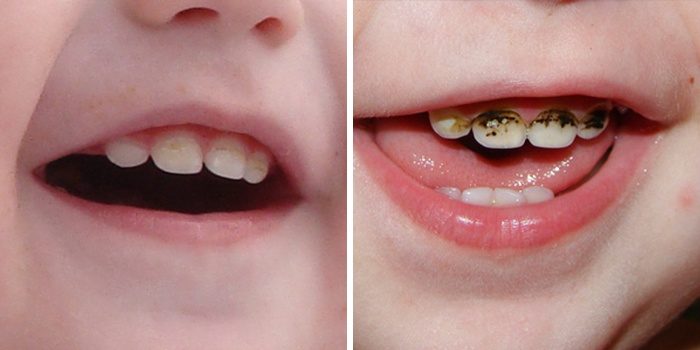 Серебрение молочных зубов у детей почему от этой процедуры стоит отказаться