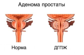 adenoma prostaty