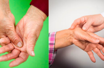 artrit palcev ruk 1