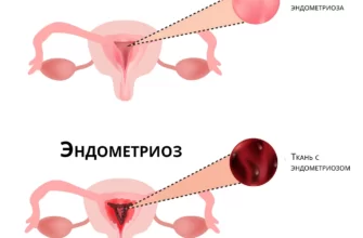 endometrioz pri klimakse