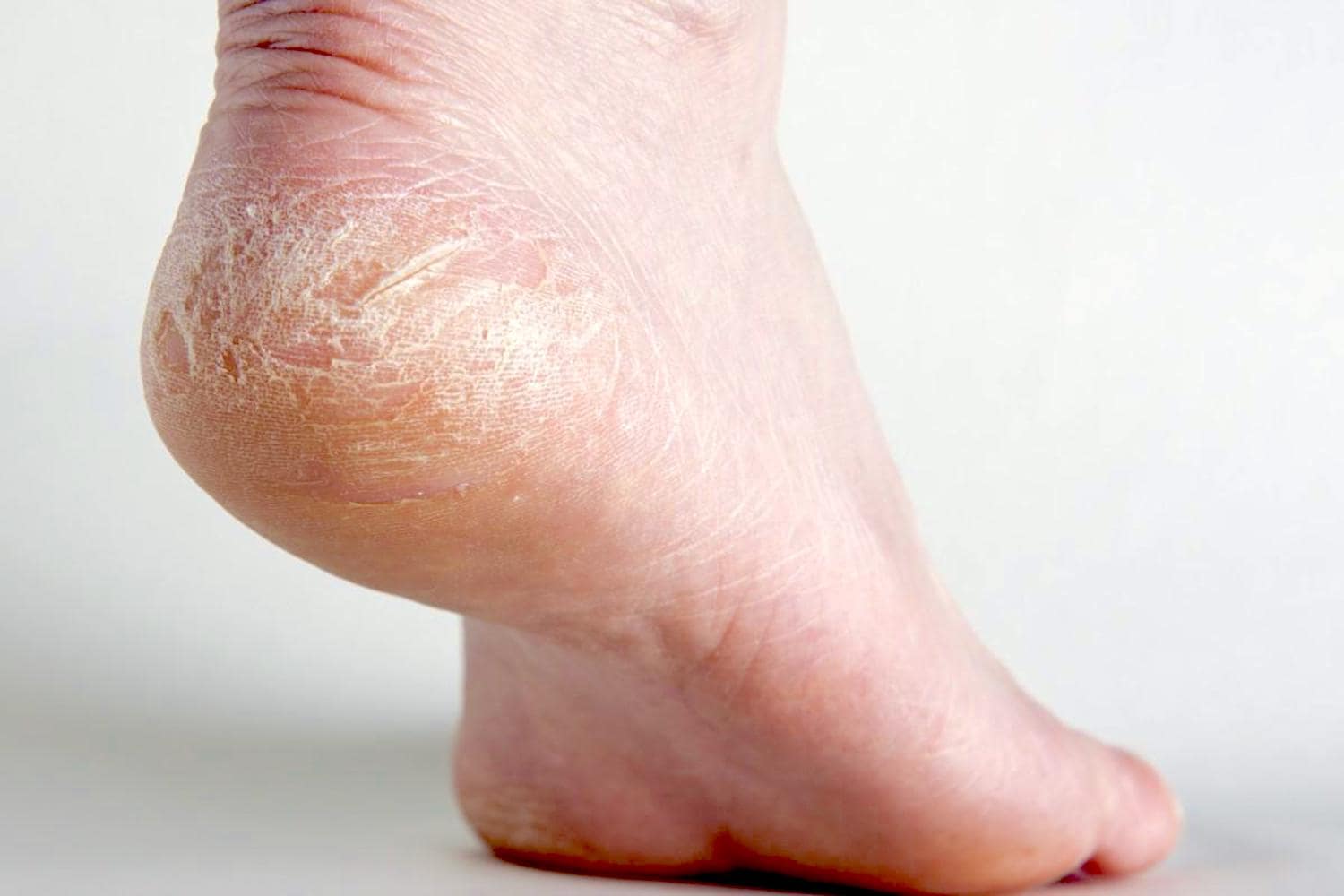 Как справиться с проблемой сухой и грубой кожи на ногах?