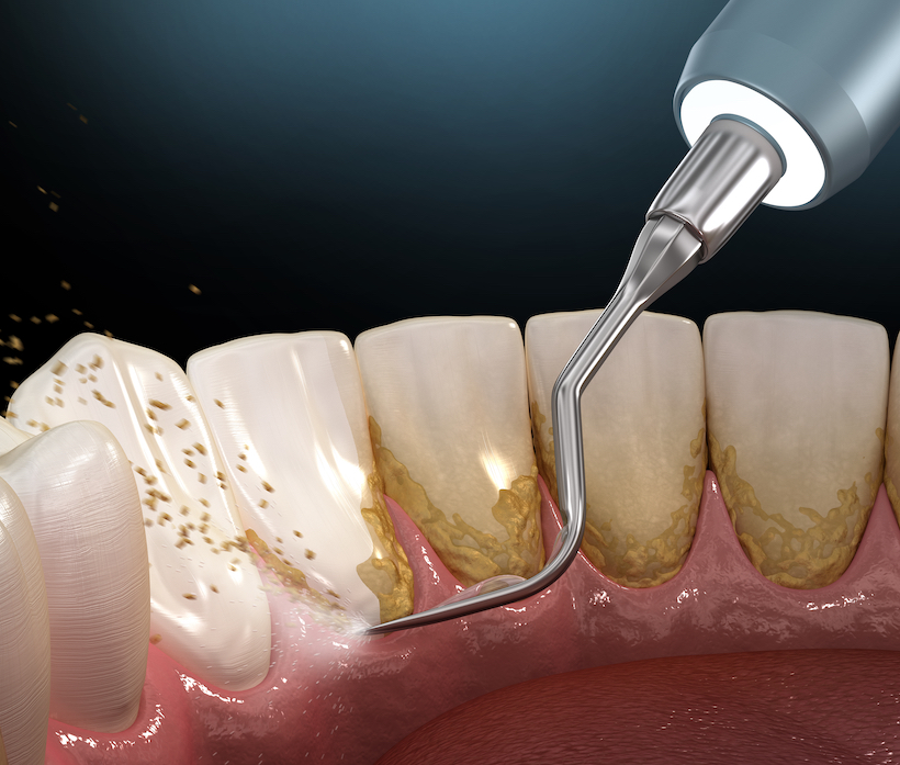 Что можно и что нельзя делать после удаления зуба 6 правил от стоматолога