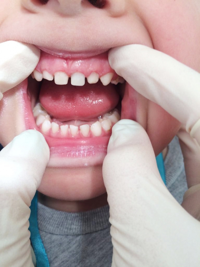 Зачем серебрят зубы детям