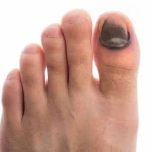 Болит ушибленный палец на ноге когда нужно к врачу