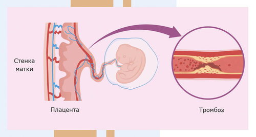 Наследственная тромбофилия и беременность