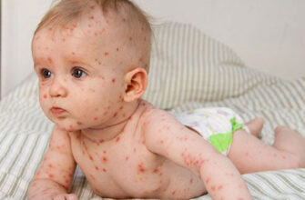 what is chickenpox
