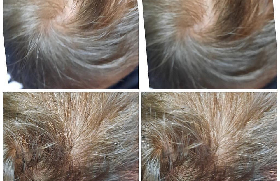 Показания для проведения мезотерапии для волос: